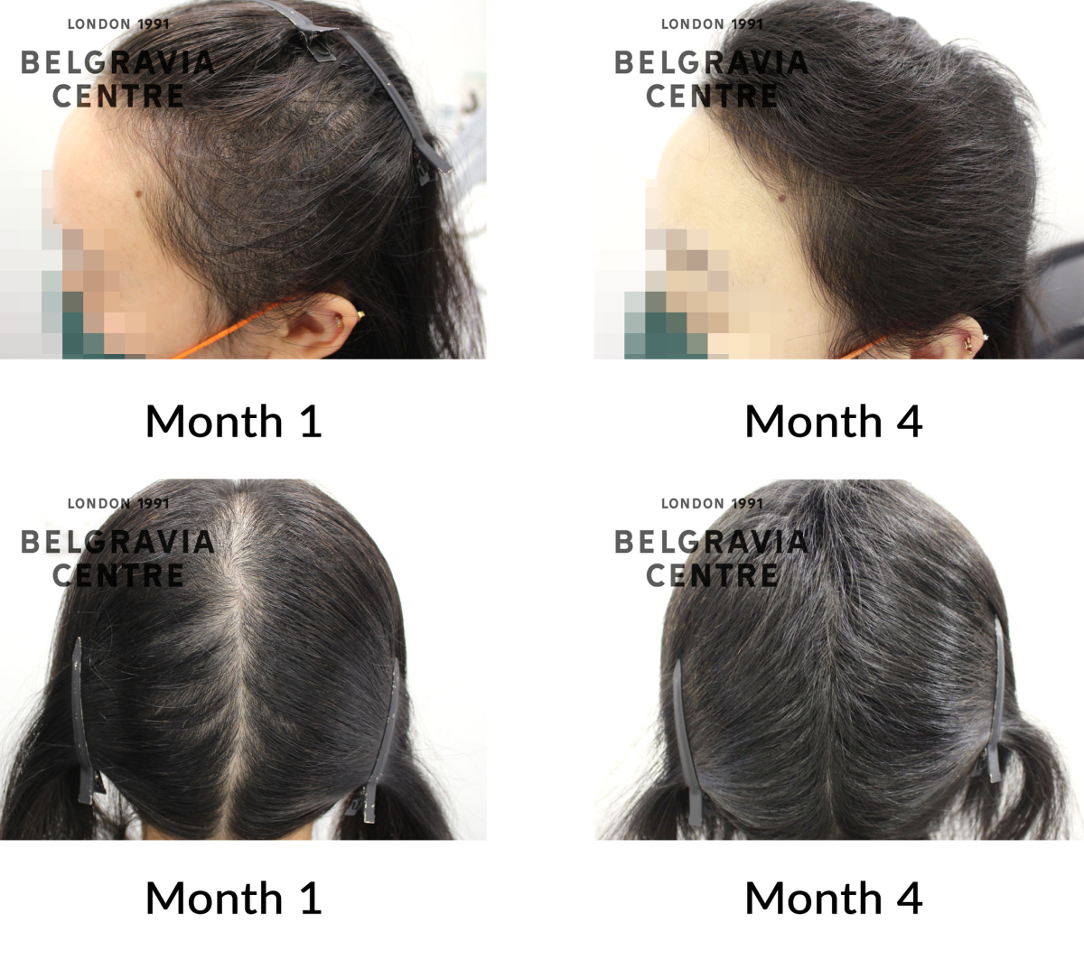 telogen fffluvium and female pattern hair loss the belgravia centre 434725