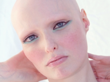 Bald Model with Alopecia Universalis Hits Catwalk