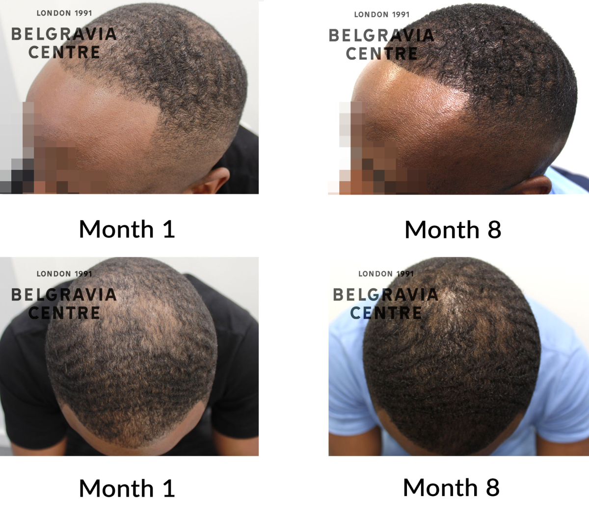 male pattern hair loss the belgravia centre 389880