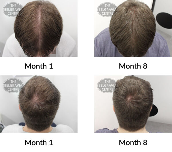 male pattern hair loss the belgravia centre 409826 13 07 2021