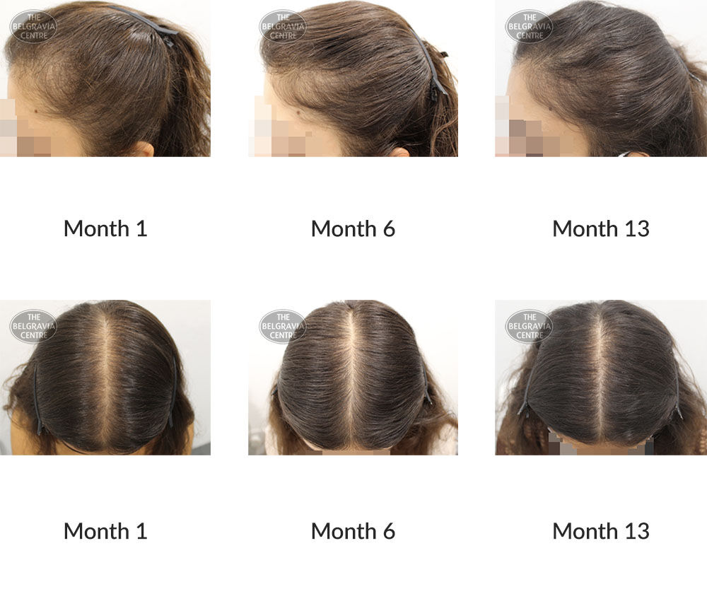 female pattern hair loss and diffuse hair loss the belgravia centre 389536 23 10 2020