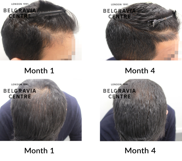 male pattern hair loss the belgravia centre 451766