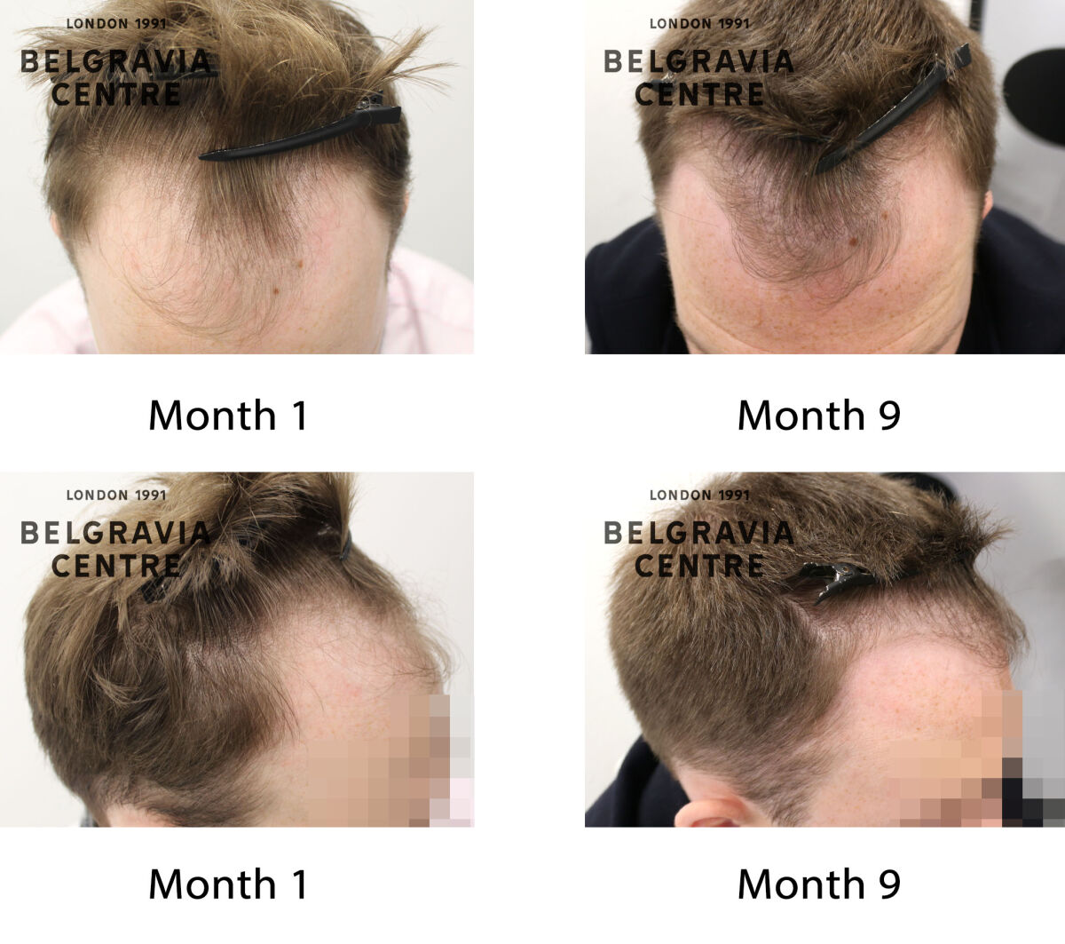 male pattern hair loss the belgravia centre 427387