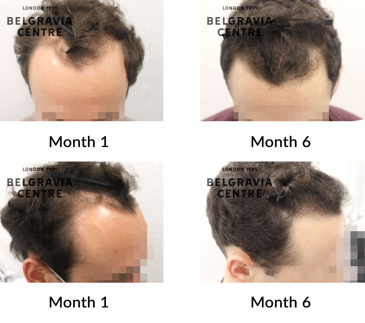 male pattern hair loss the belgravia centre 432480