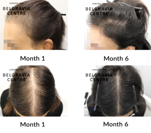 female pattern hair loss the belgravia centre 465952