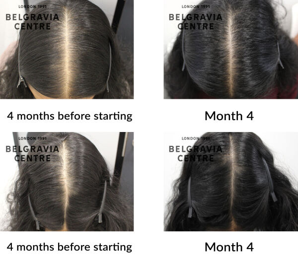 female pattern hair loss the belgravia centre 442711