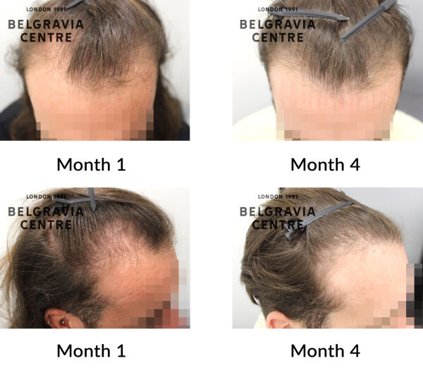 male pattern hair loss the belgravia centre 446292