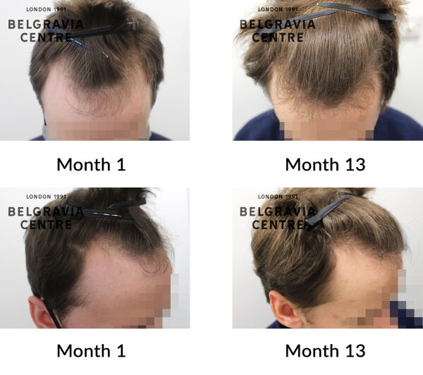 male pattern hair loss the belgravia centre 436052
