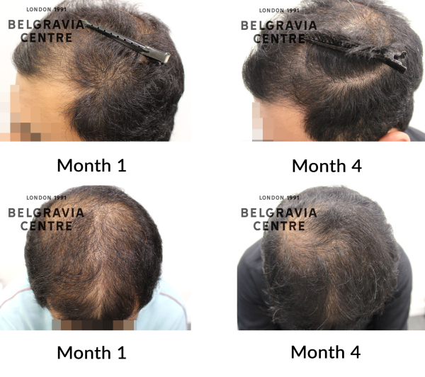male pattern hair loss the belgravia centre 466892