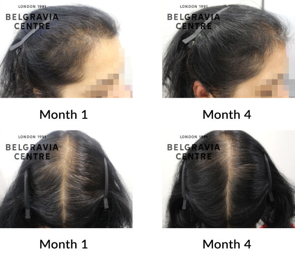 female pattern hair loss the belgravia centre 438409