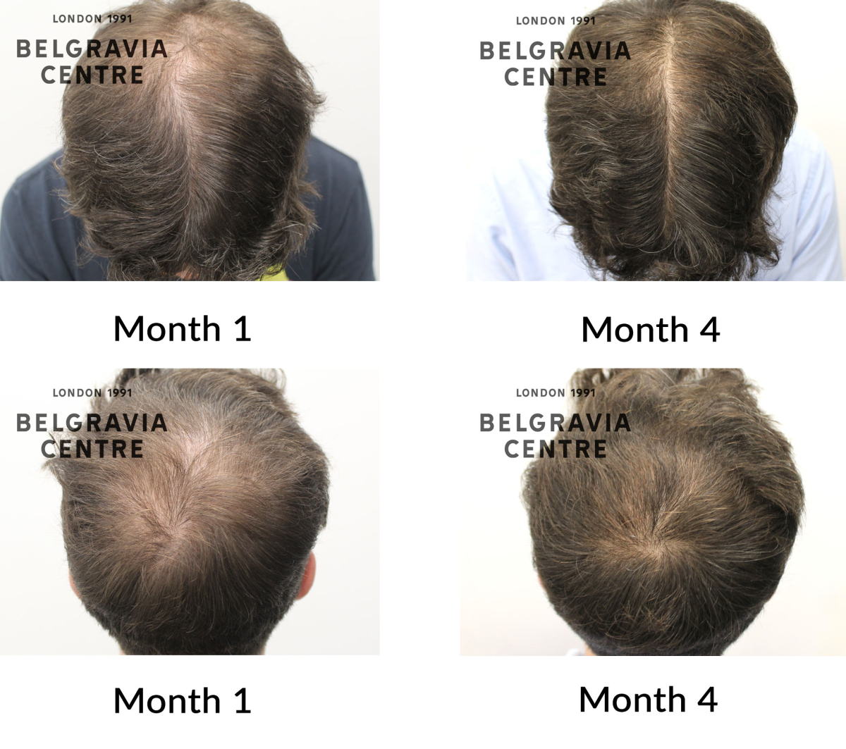 male pattern hair loss the belgravia centre 460277
