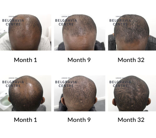 male pattern hair loss the belgravia centre 347458