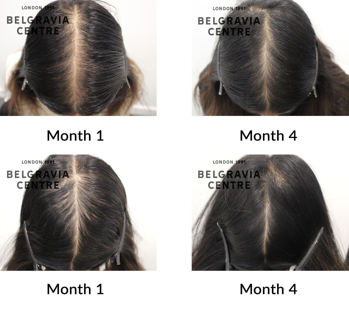 female pattern hair loss and telogen effluvium the belgravia centre 450814