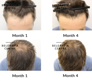 male pattern hair loss the belgravia centre 458182