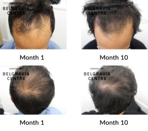 male pattern hair loss the belgravia centre 424284