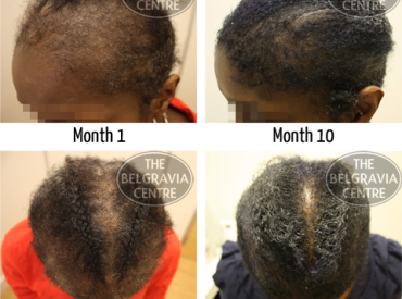 Traction Alopecia and FDS Photoscans The Belgravia Centre