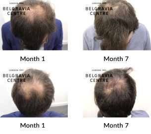 male pattern hair loss the belgravia centre 442749