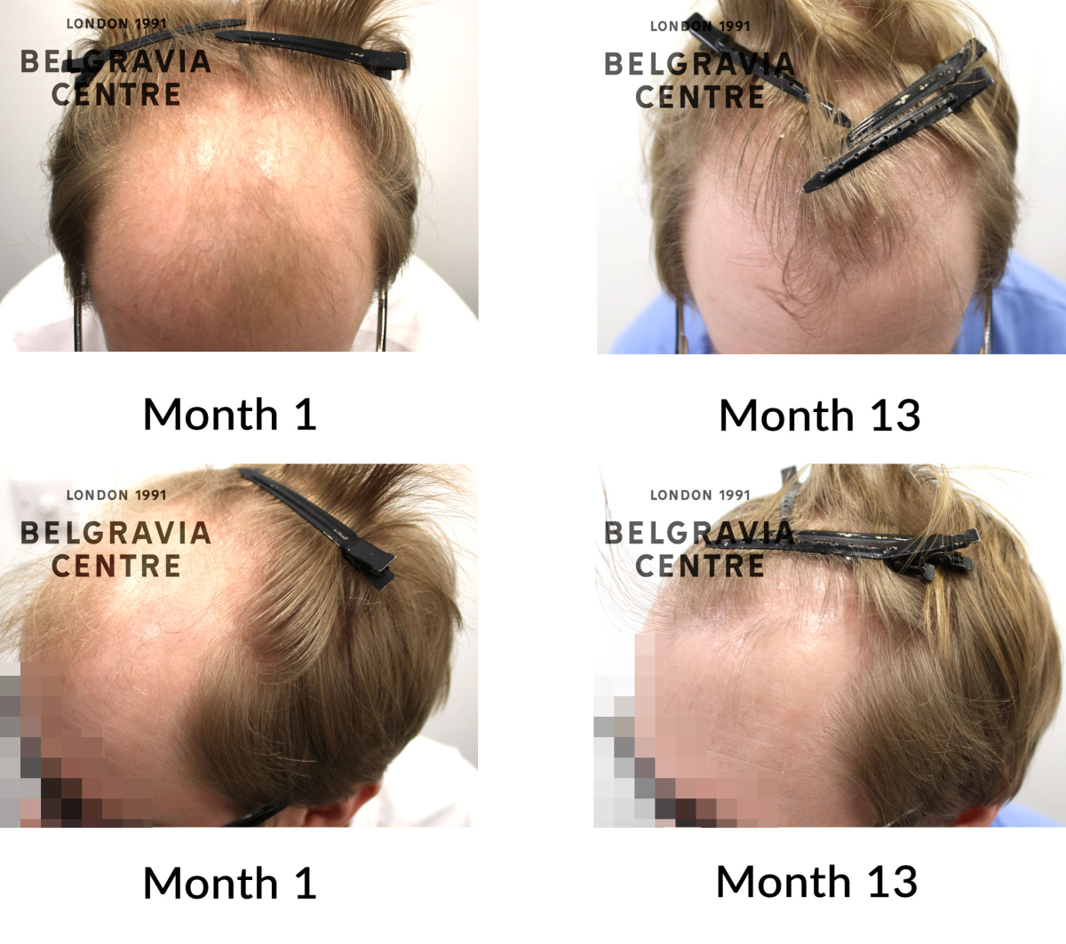 male pattern hair loss the belgravia centre 449696