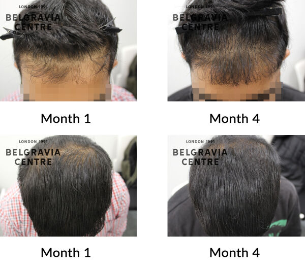 male pattern hair loss the belgravia centre 442618