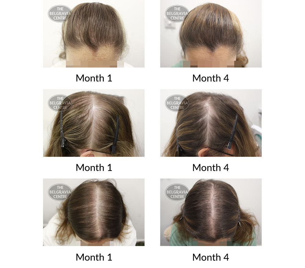 female pattern hair loss and diffuse thinning the belgravia centre 239624 22 11 2021