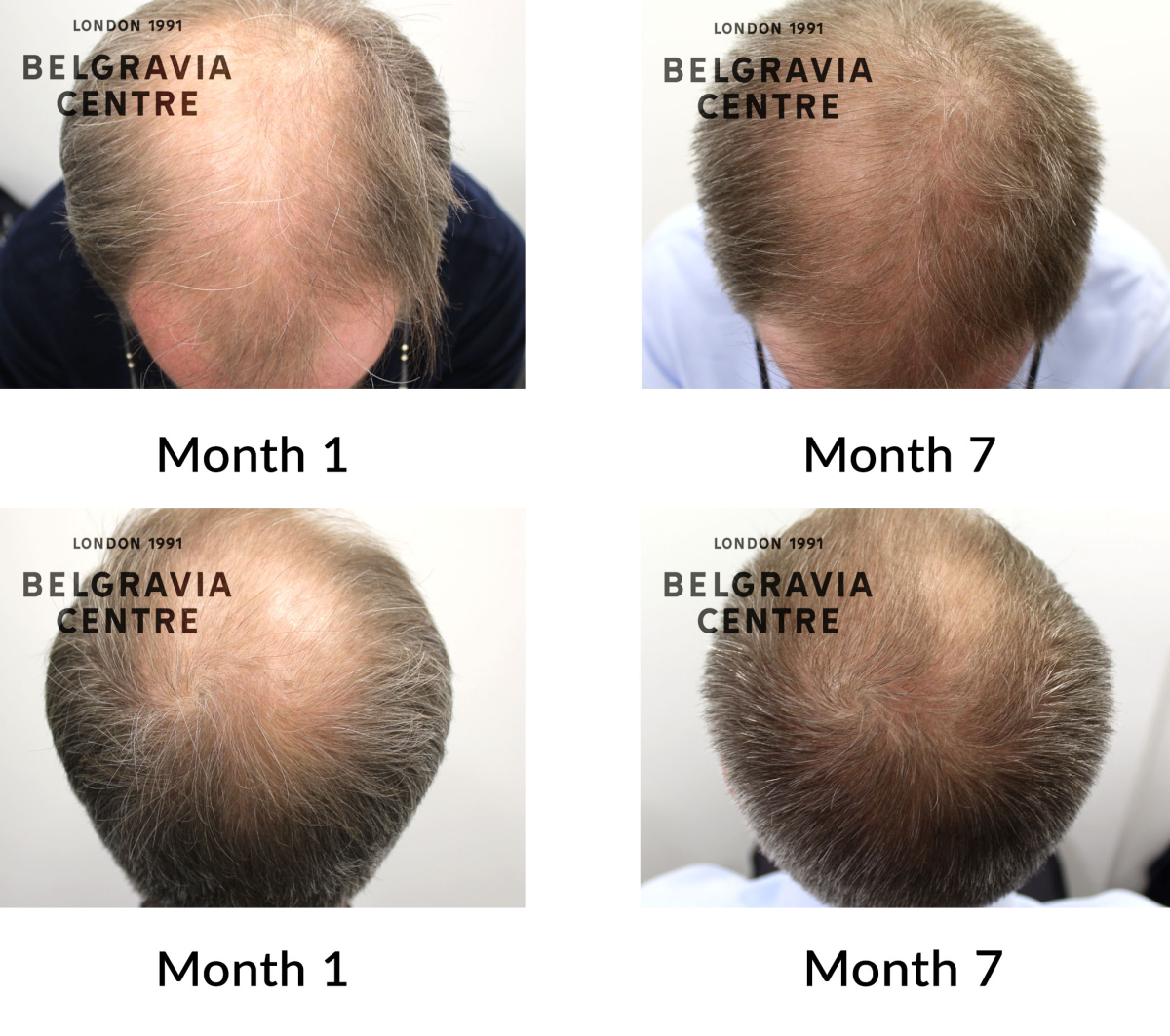 male pattern hair loss the belgravia centre 89282