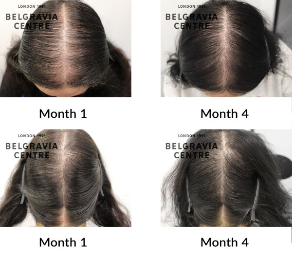 female pattern hair loss the belgravia centre 434162