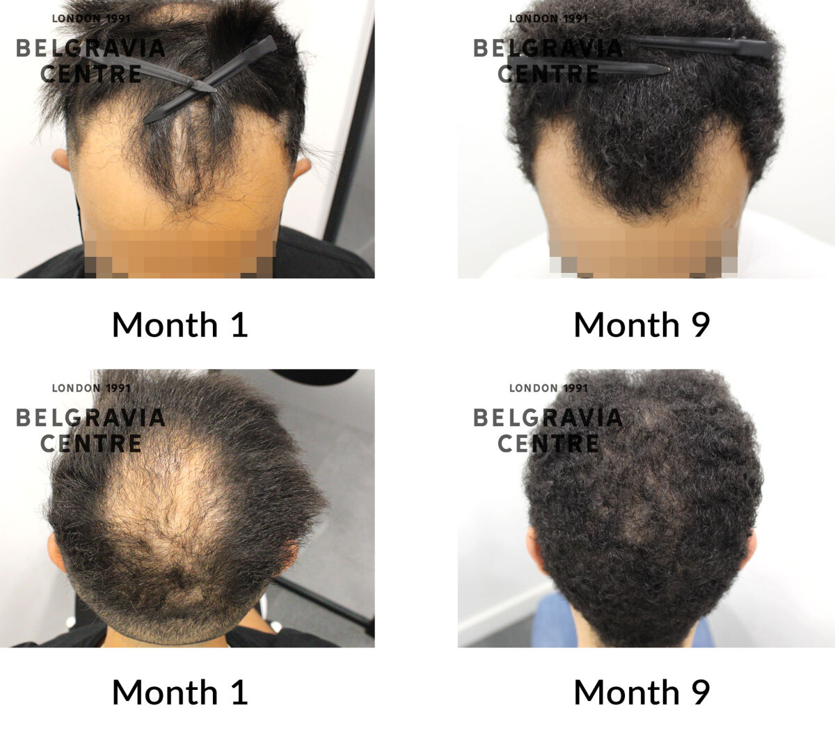 male pattern hair loss the belgravia centre 424908
