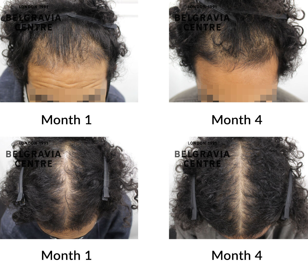 male pattern hair loss the belgravia centre 436489