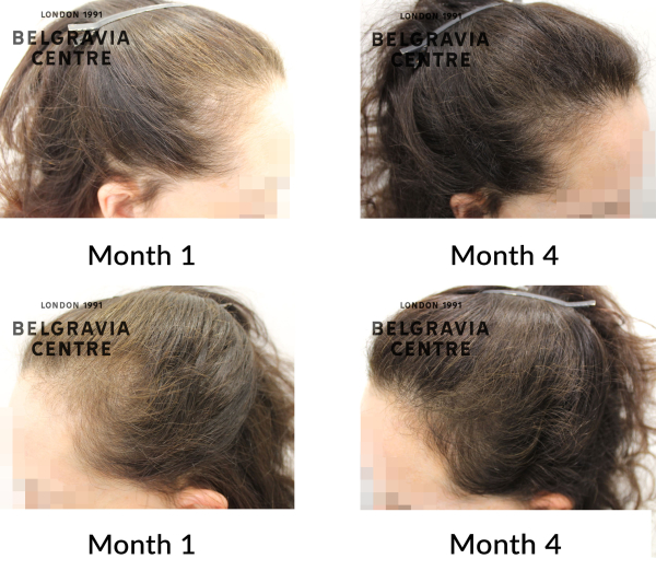 female pattern hair loss and telogen effluvium chronic the belgravia centre 453476