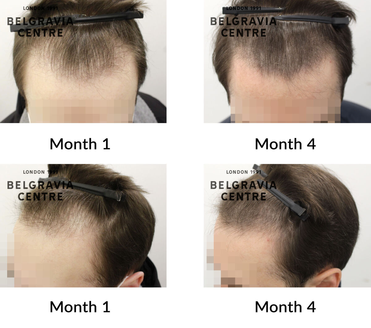 male pattern hair loss the belgravia centre 436121