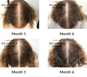 female pattern hair loss and diffuse thinning the belgravia centre 428349