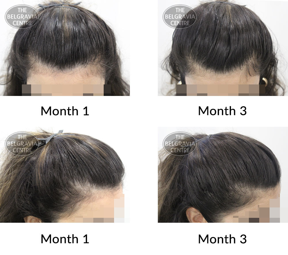 female pattern hair loss the belgravia centre 425195 21 09 2021