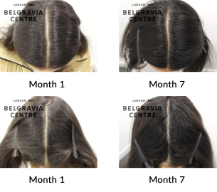 female pattern hair loss the belgravia centre 431537