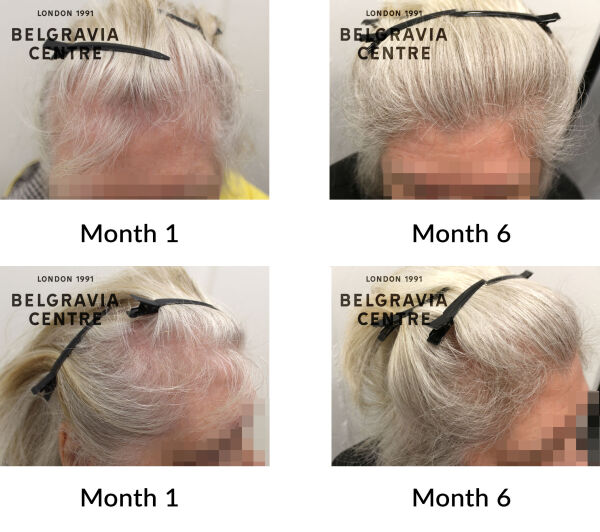 female pattern hair loss the belgravia centre 445849