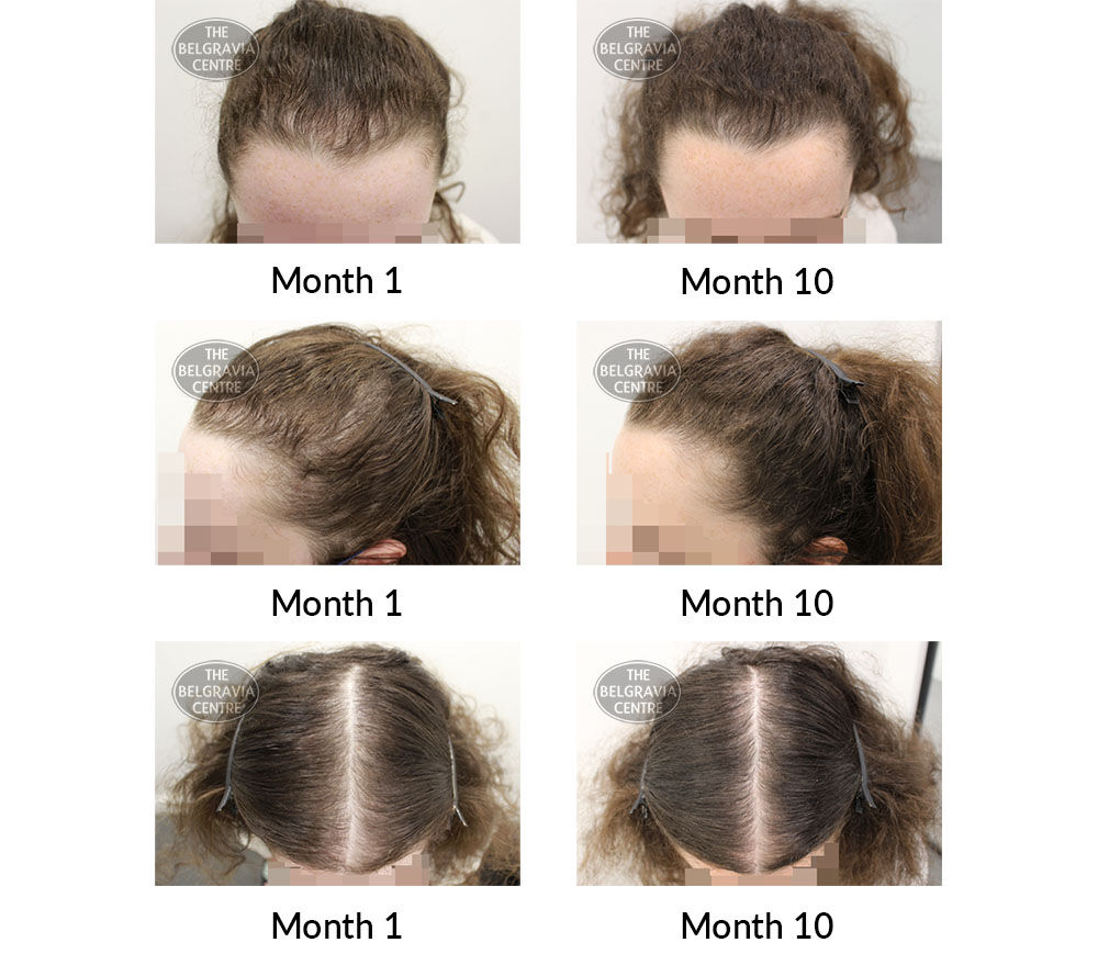 female pattern hair loss and diffuse thinning the belgravia centre 406668 24 06 2021