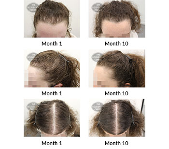 alert female pattern hair loss and diffuse thinning the belgravia centre 406668 24 06 2021