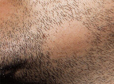 Beard hair loss alopecia barbae bald spot