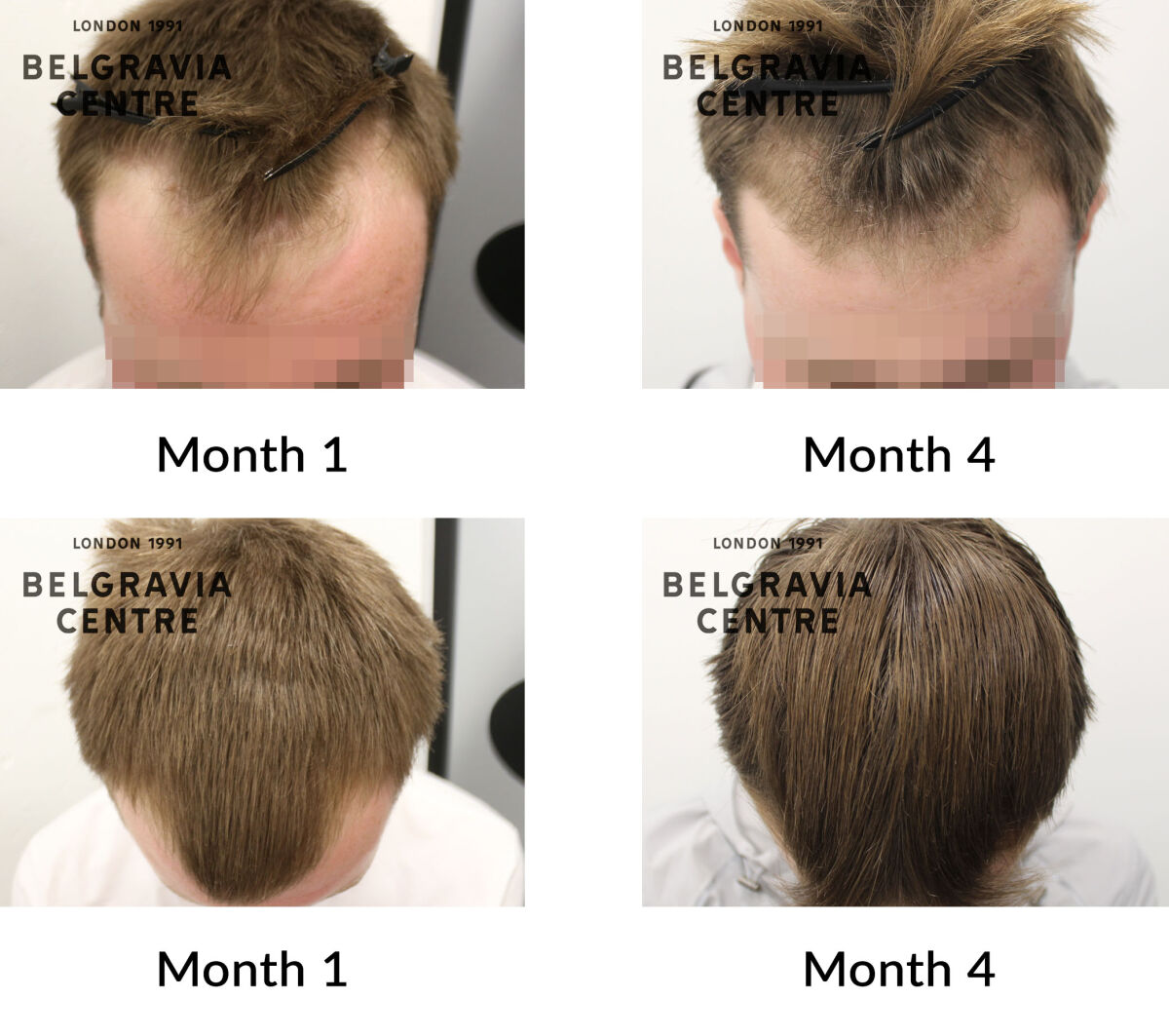 male pattern hair loss the belgravia centre 442956