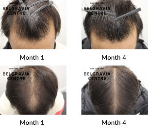male pattern hair loss the belgravia centre 445153