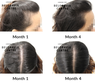female pattern hair loss the belgravia centre 408607