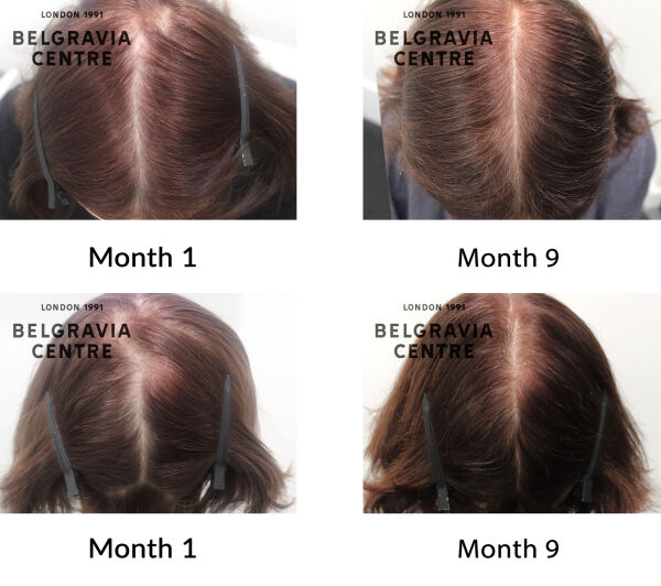 female pattern hair loss the belgravia centre 435972