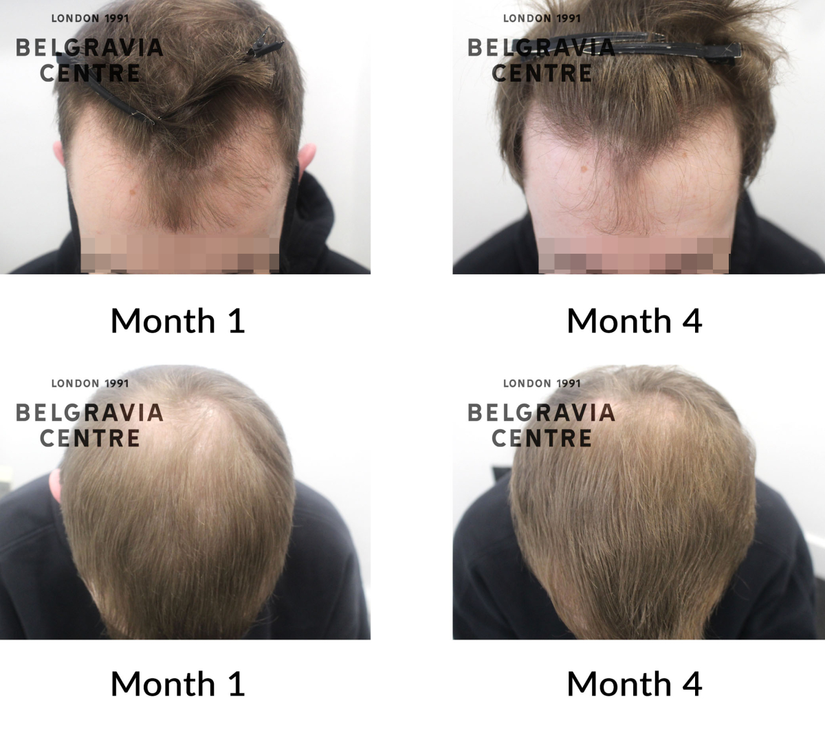 male pattern hair loss the belgravia centre 434964