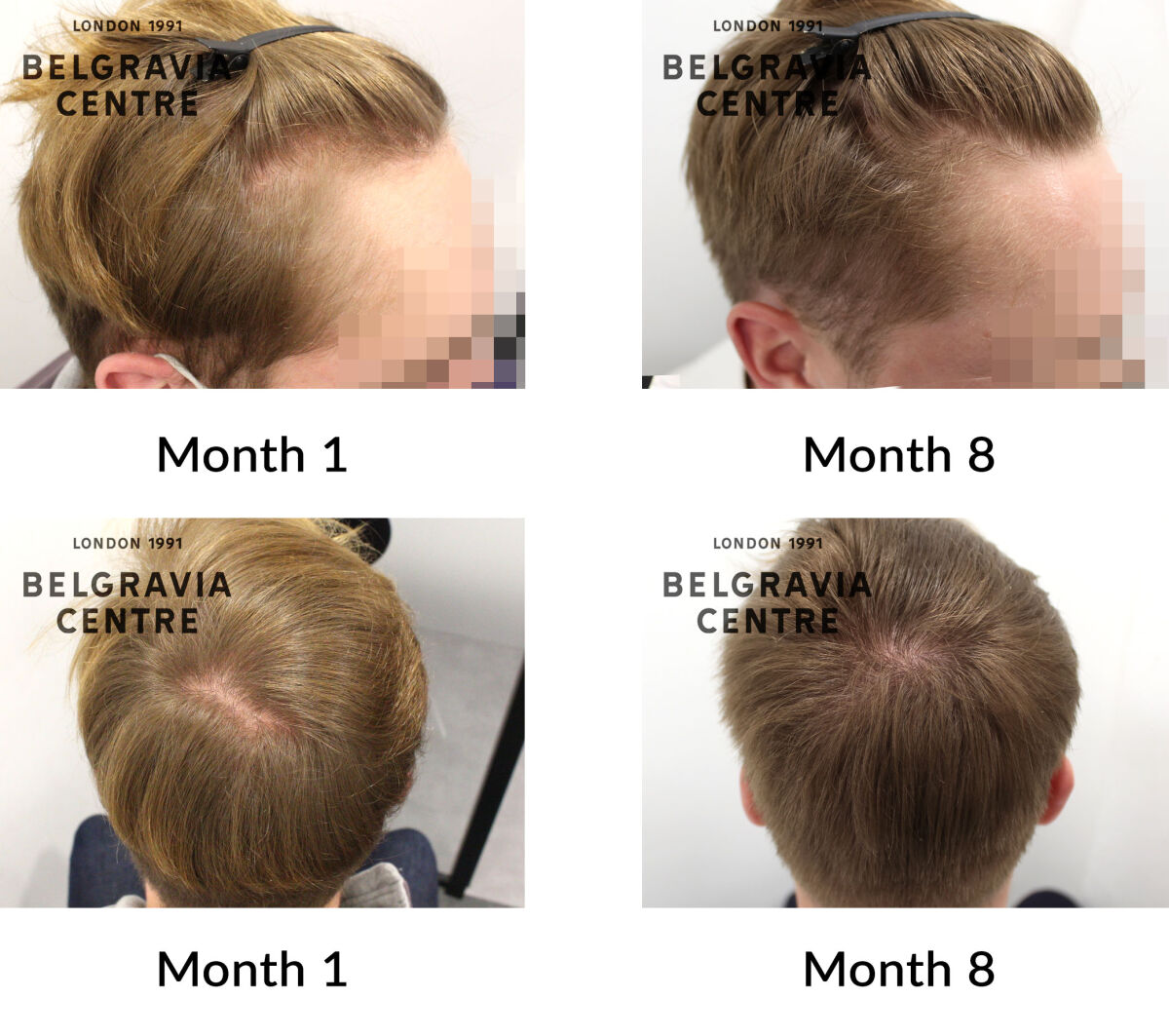 male pattern hair loss the belgravia centre 432297