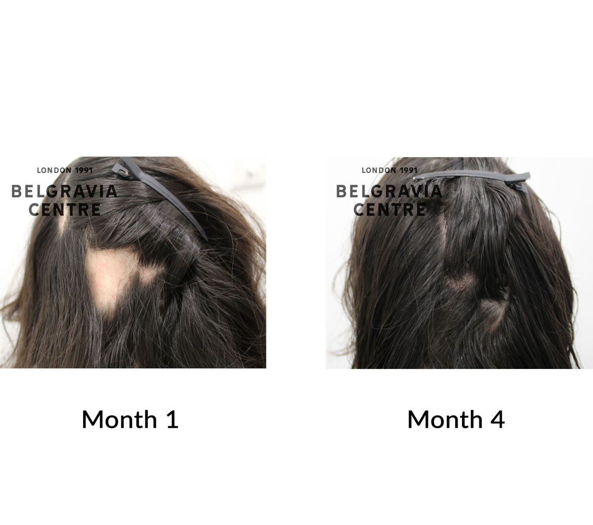alopecia areata the belgravia centre 447043