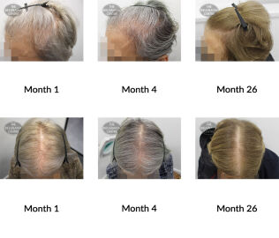 female pattern hair loss the belgravia centre 381878 22 06 2021