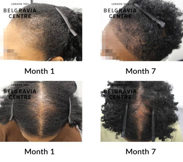follicular degeneration syndrome and female pattern hair loss the belgravia centre 434633