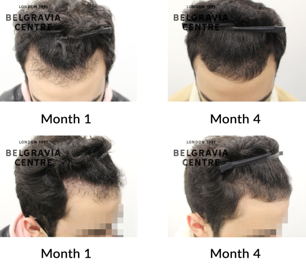 How To Regrow Baby Hairs After Hair Thinning?