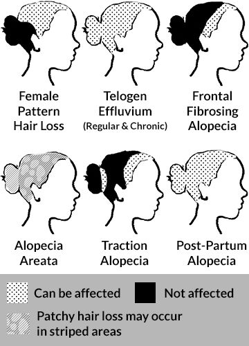 Common womens hair loss conditions areas of the scalp affected thinning hair baldness womens Belgravia Centre