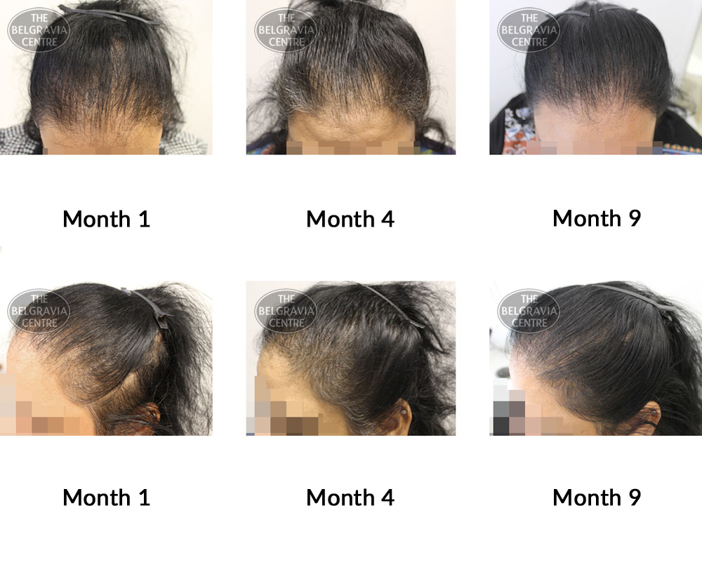 female pattern hair loss the belgravia centre 368119 27 06 2019