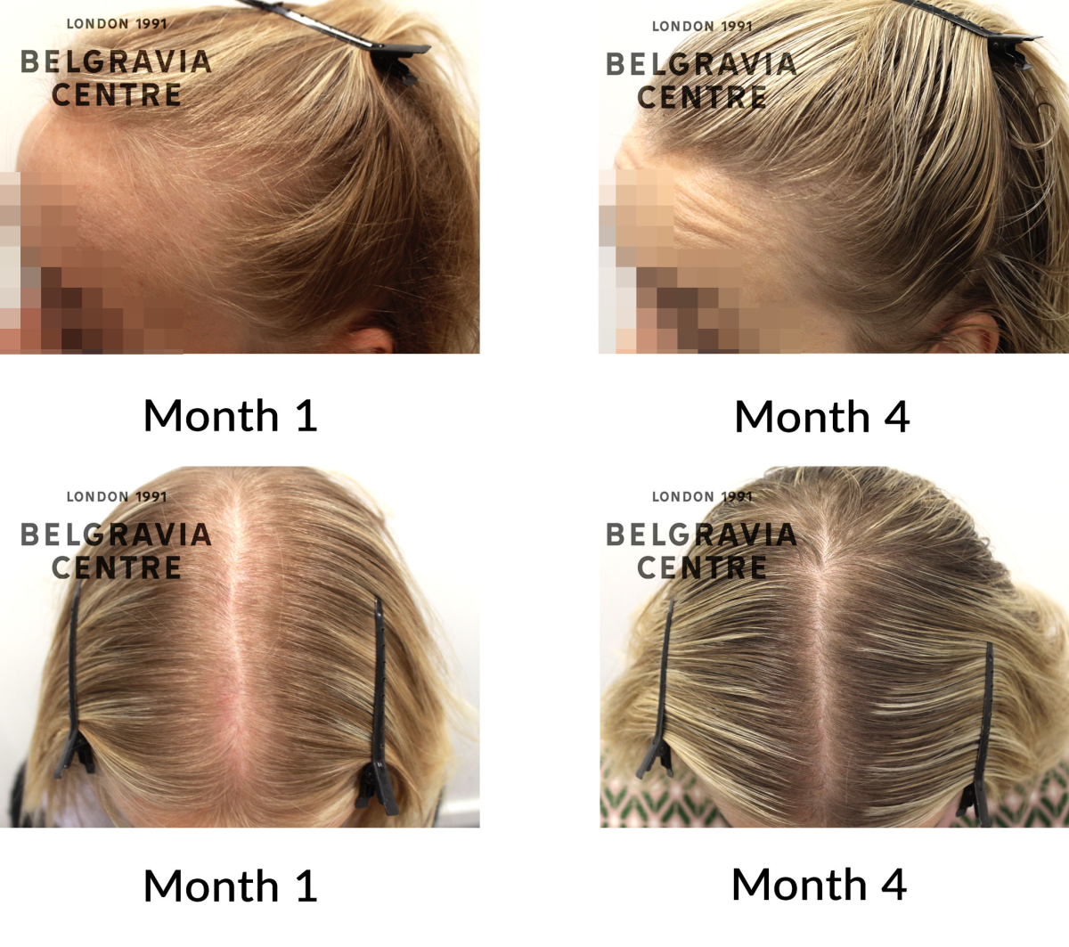 female pattern hair loss the belgravia centre 464493